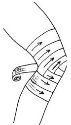 Черепашья повязка на область коленного сустава – расходящаяся