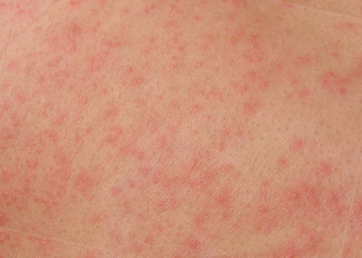 кожа при аллергии