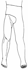 Гипсовая тазобедренная повязка для фиксации тазобедренного сустава