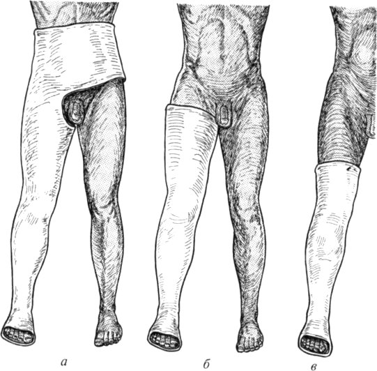 Объем гипсовой повязки при повреждении