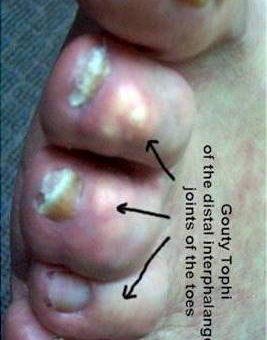 Подагрический артрит суставов пальцев стопы