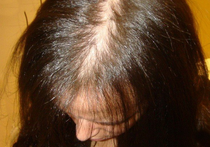 выпадение волос