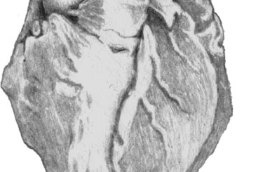 Атеросклероз венечной артерии сердца