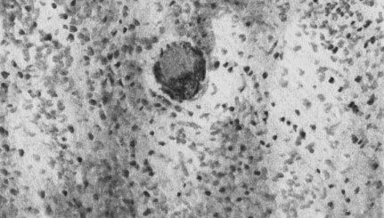 Бруцеллезная гранулома, состоящая из эпителио- идных клеток. В центре — гигантская клетка