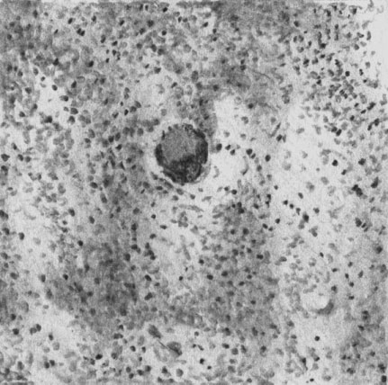 Бруцеллезная гранулома, состоящая из эпителиоидных клеток. В центре — гигантская клетка