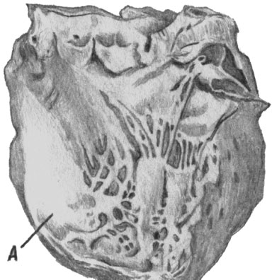 Хроническая аневризма (А) левого желудочка сердца на почве рубцового замещения ткани миокарда после инфаркта