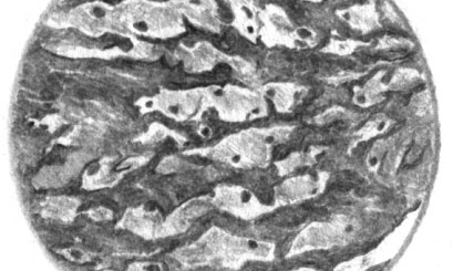 Ксантомные клетки в атеросклеротической бляшке