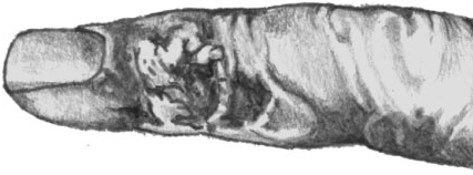 Палец больного туляремией (язва)