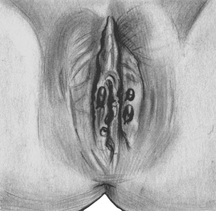 Первичная сифилома (эрозивная форма) на половых органах женщины
