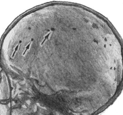 Рентгенография черепа больного токсоплазмозом