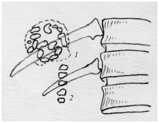 рентгеновский снимок камней желчного протока
