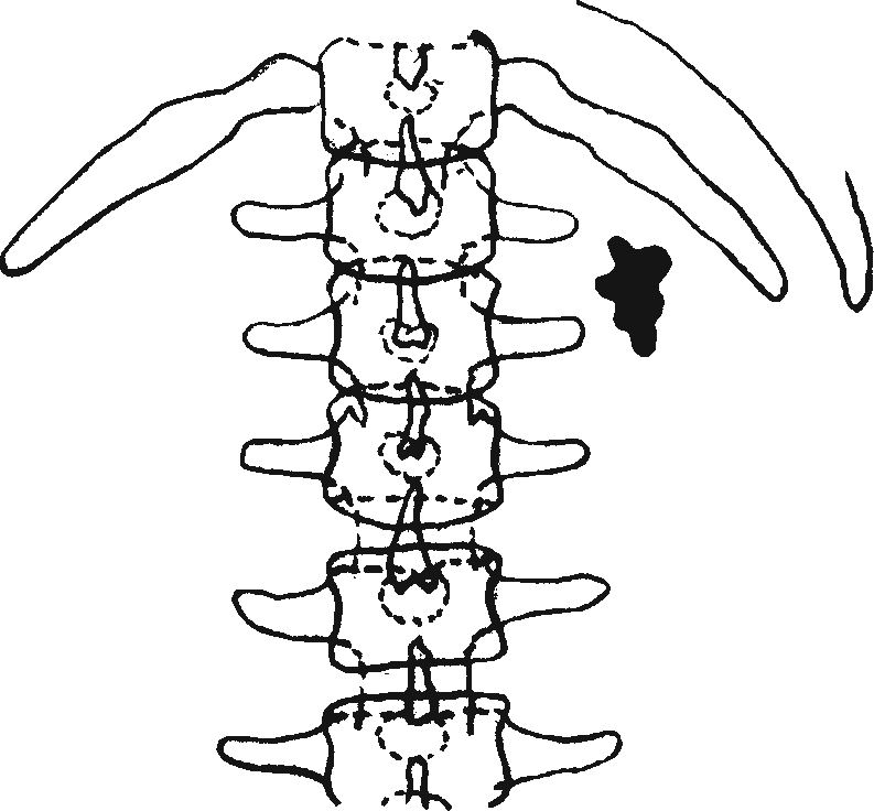 Схема рентгеновского снимка при лоханочном камне почки