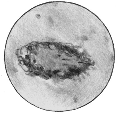 Сибиреязвенный менингоэнцефалит. Массы бацилл кольцом окружают сосуд