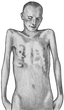Скорбут. Западение грудины вследствие разъединения хрящевидных и костных частей ребер
