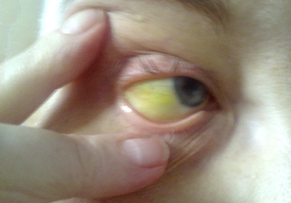 желтуха - глаз желтый